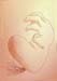 heartburn